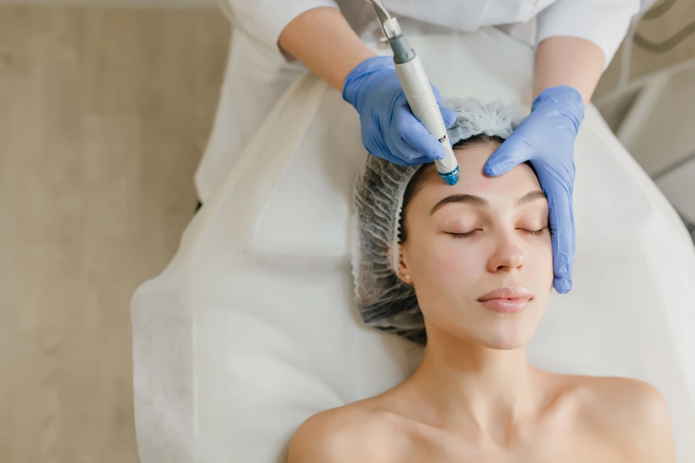 Microneedling treatment performed on the forehead to support smoother skin texture in Kirkland, WA.