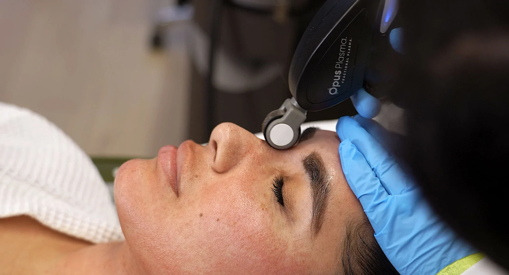 Opus Plasma treatment applied to the face for skin resurfacing and rejuvenation in Kirkland, WA.
